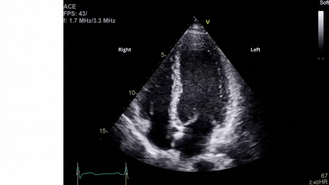 Moving image (GIF) showing an ultrasound of a healthy heart 
